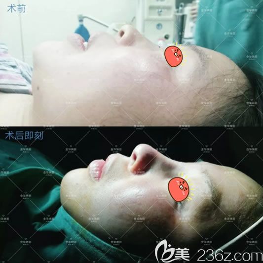 金華瑞麗假體隆鼻案例即刻效果 金華瑞麗假體隆鼻案例即刻效果