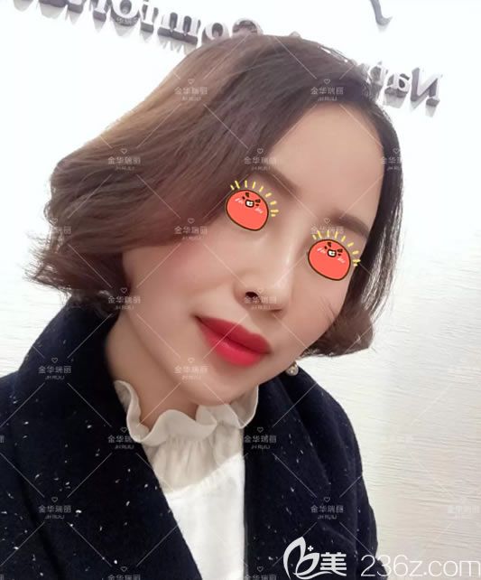 想知道隆鼻術后多久消腫的姐妹們,可以參考我在金華瑞麗劉政這做完假體隆鼻的恢復過程