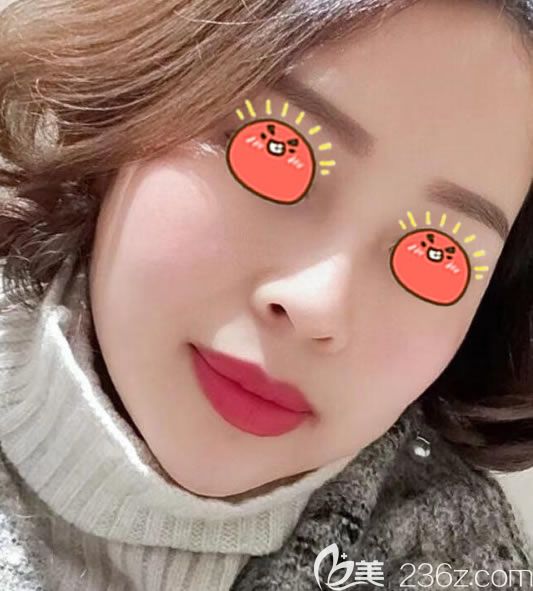 金華瑞麗劉政假體隆鼻案例 金華瑞麗劉政假體隆鼻案例