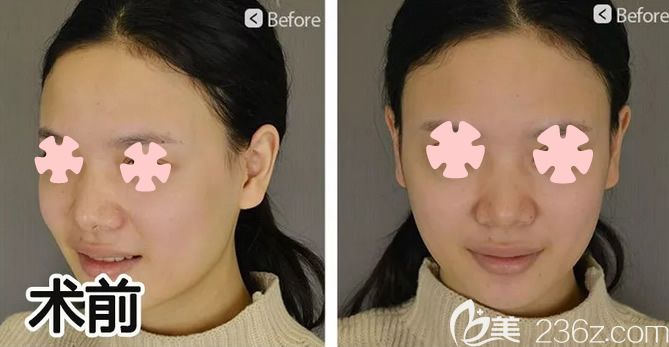 我在柳州華美做全臉自體脂肪填充前的照片 我在柳州華美做全臉自體脂肪填充前的照片