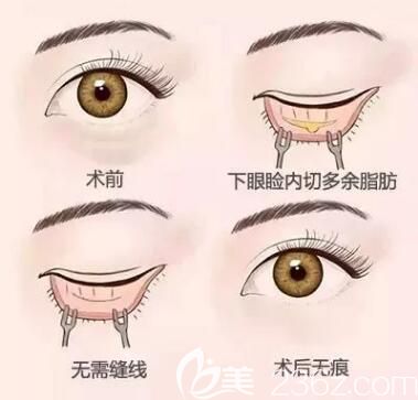 常州曙光韓式內(nèi)吸去眼袋技術(shù) 常州曙光韓式內(nèi)吸去眼袋技術(shù)