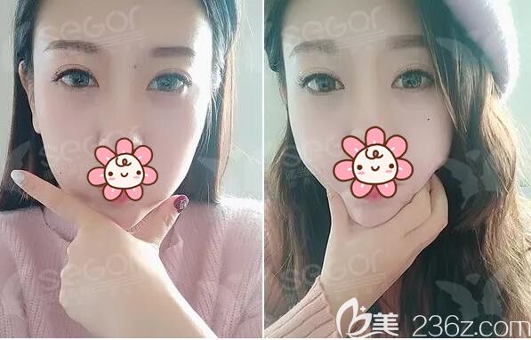 怕縫合拆線恢復(fù)期影響工作，就到常州曙光做了韓式內(nèi)吸祛眼袋告別遺傳+熬夜形成的大眼袋