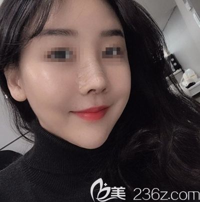 韓國(guó)玉芭做了隆鼻修復(fù)手術(shù)后7天