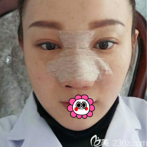 佳木斯韓藝來(lái)找李明賢做的鼻綜合3天