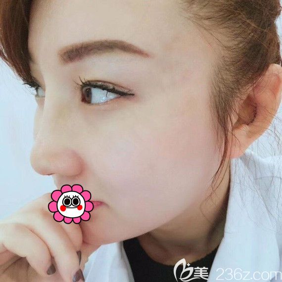 佳木斯韓藝來(lái)耳軟骨隆鼻術(shù)后7天