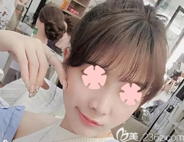 直播我在柳州華美整形做鼻綜合隆鼻+全面部自體脂肪填充術(shù)后100天恢復(fù)過程