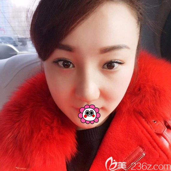 李明賢耳軟骨隆鼻恢復(fù)1個(gè)月