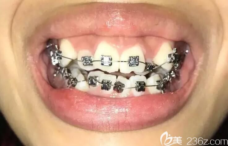 美奧口腔戴鋼牙套天是不是有點(diǎn)小丑 美奧口腔戴鋼牙套天是不是有點(diǎn)小丑