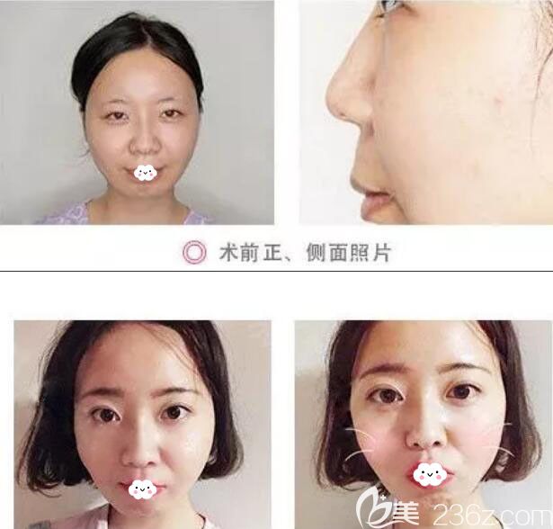 韓國愛慕整形李炫直人中縮短術(shù)案例效果圖 韓國愛慕整形李炫直人中縮短術(shù)案例效果圖