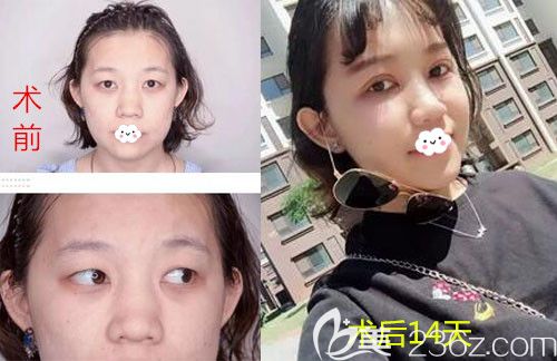 韓國愛慕雙眼皮前后效果對(duì)比圖 韓國愛慕雙眼皮前后效果對(duì)比圖