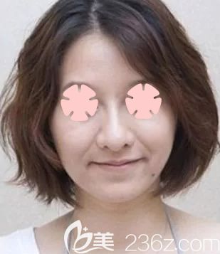 我在柳州仁美整形做全臉線雕提升前的照片 我在柳州仁美整形做全臉線雕提升前的照片