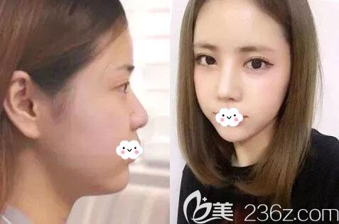 韓國愛慕整形外科醫(yī)院韓式隆鼻案例 韓國愛慕整形外科醫(yī)院韓式隆鼻案例