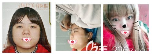 孫蘇寧醫(yī)生做雙眼皮案例