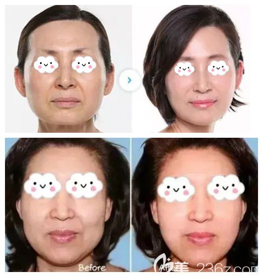 王晉茹做激光除皺案例