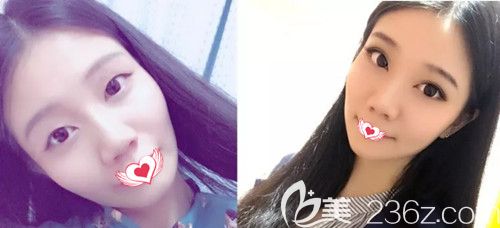 石家莊天宏做雙眼皮和射頻除皺得多少錢?3月整形優(yōu)惠都只需880元