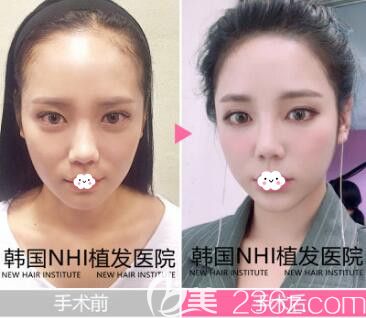 韓國江南NHI發(fā)際線種植案例效果對比圖