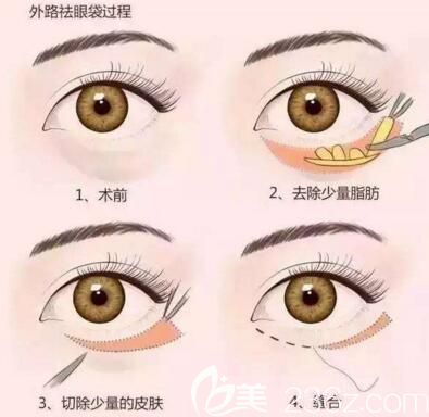 外路去除眼袋法過程