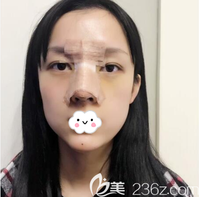 成都西區(qū)醫(yī)院車紅昌隆鼻術(shù)后即刻照片 成都西區(qū)醫(yī)院車紅昌隆鼻術(shù)后即刻照片