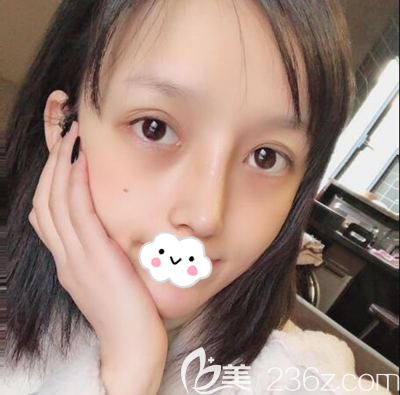 車紅昌肋軟骨鼻綜合拆線后效果 車紅昌肋軟骨鼻綜合拆線后效果