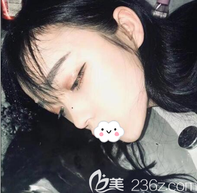 肋軟骨隆鼻術(shù)后半個(gè)月恢復(fù)照片 肋軟骨隆鼻術(shù)后半個(gè)月恢復(fù)照片