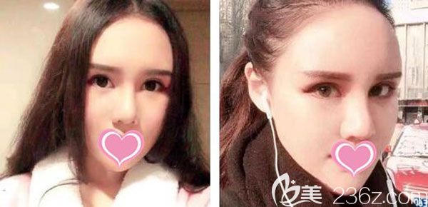 面部抽脂第7天恢復(fù)的還不錯(cuò) 面部抽脂第7天恢復(fù)的還不錯(cuò)