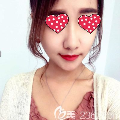 西寧康華<!--<i data=20240703-sp></i>-->院長(zhǎng)給我注射玻尿酸豐下巴術(shù)后第7天效果