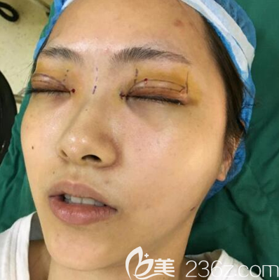 鄧東偉眼綜合手術(shù)術(shù)前設(shè)計