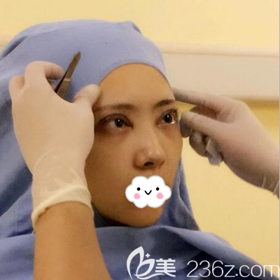 成都西區(qū)醫(yī)院鄧東偉術(shù)后調(diào)整雙眼皮形狀
