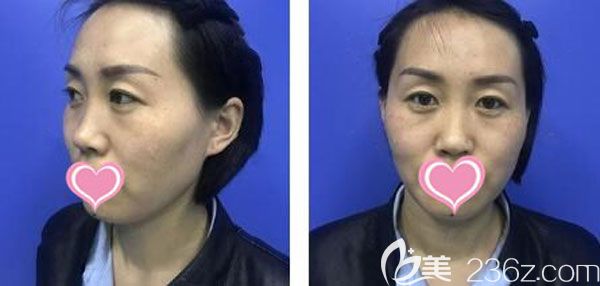 在昆明韓辰做脂肪填充面部手術前 在昆明韓辰做脂肪填充面部手術前