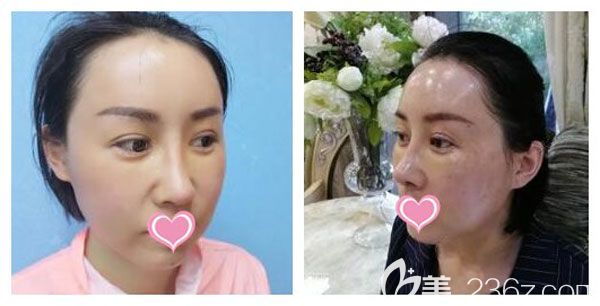 全臉脂肪填充第3—5天恢復圖 全臉脂肪填充第3—5天恢復圖