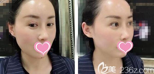 脂肪填充15天淤青也已經不明顯 脂肪填充15天淤青也已經不明顯