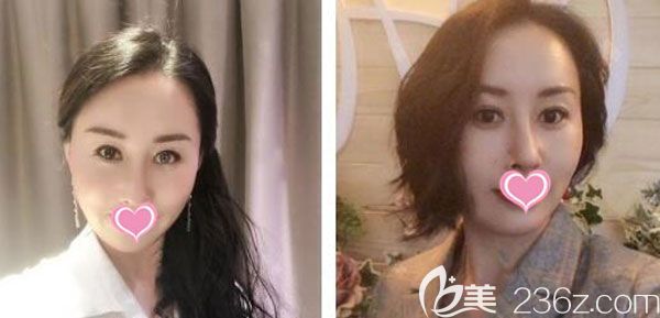 面部脂肪填充第20天皮膚光滑圓潤 面部脂肪填充第20天皮膚光滑圓潤