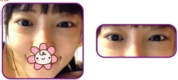 常熟時(shí)代定制無(wú)痕祛眼袋術(shù)后天