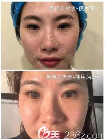 毛明艷醫(yī)生祛斑案例前后對比 毛明艷醫(yī)生祛斑案例前后對比