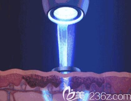 光動力祛斑的原理