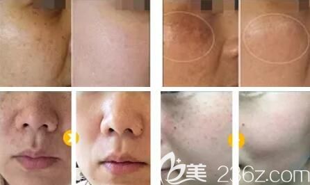 東湖光動力祛斑真人案例