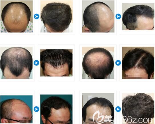 韓國JP毛發(fā)移植植發(fā)案例 韓國JP毛發(fā)移植植發(fā)案例