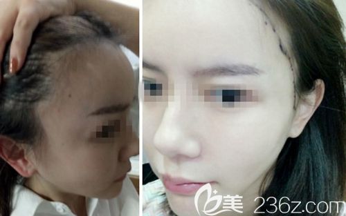 在韓國(guó)JP毛發(fā)移植中心做發(fā)際線移植前 在韓國(guó)JP毛發(fā)移植中心做發(fā)際線移植前