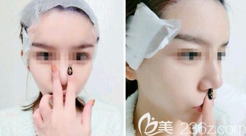 在韓國(guó)JP毛發(fā)移植中心做發(fā)際線移植后8天 在韓國(guó)JP毛發(fā)移植中心做發(fā)際線移植后8天