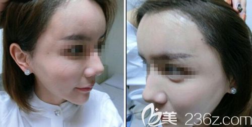 在韓國(guó)JP毛發(fā)移植中心做發(fā)際線移植后17天 在韓國(guó)JP毛發(fā)移植中心做發(fā)際線移植后17天