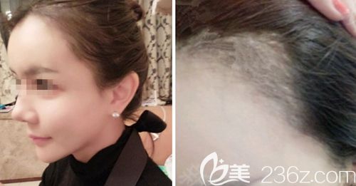 在韓國(guó)JP毛發(fā)移植中心做發(fā)際線移植后1個(gè)月 在韓國(guó)JP毛發(fā)移植中心做發(fā)際線移植后1個(gè)月