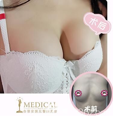 合肥白領(lǐng)安琪兒整形<!--<i data=20240703-sp></i>-->案例效果公布 合肥白領(lǐng)安琪兒整形<!--<i data=20240703-sp></i>-->案例效果公布