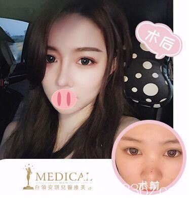 <!--<i data=20240703-sp></i>-->鼻綜合案例效果對(duì)比圖 <!--<i data=20240703-sp></i>-->鼻綜合案例效果對(duì)比圖