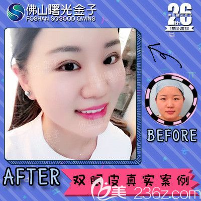 佛山曙光金子李淑薇醫(yī)生雙眼皮案例