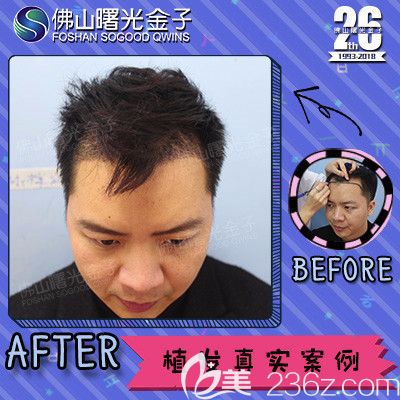 佛山曙光金子邱會銀做的植發(fā)案例