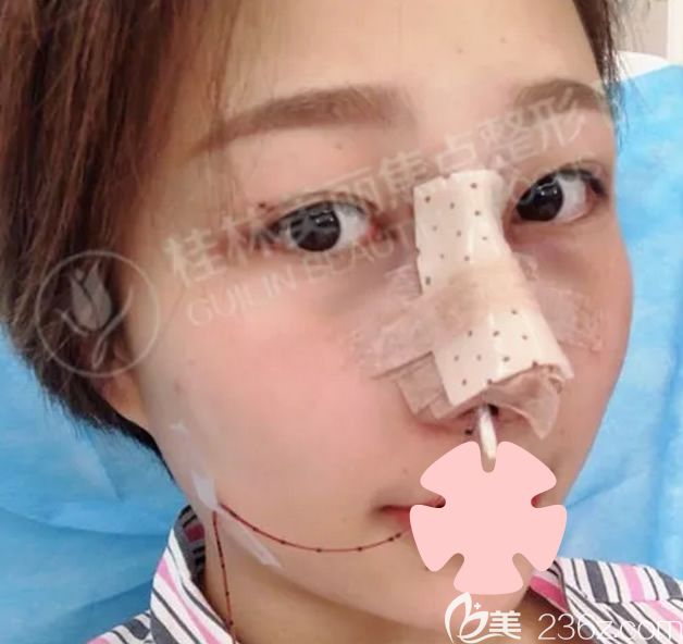 我在桂林美麗焦點做鼻綜合隆鼻術(shù)后當(dāng)天 我在桂林美麗焦點做鼻綜合隆鼻術(shù)后當(dāng)天