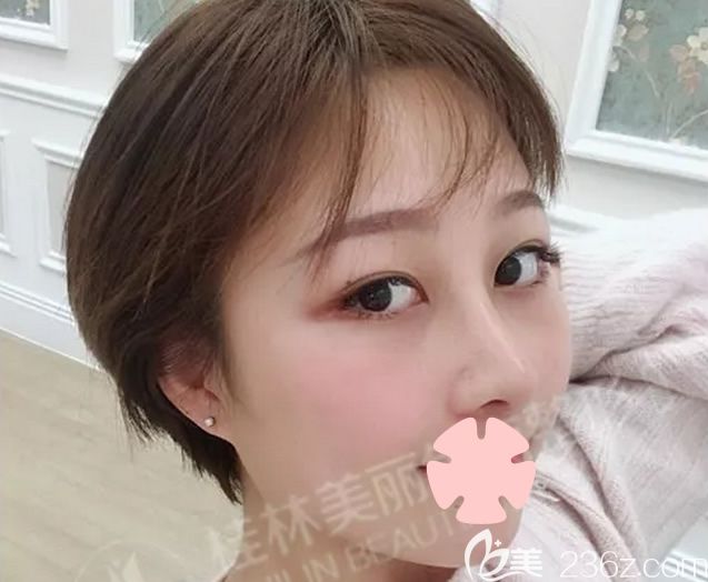 上傳我在桂林美麗焦點(diǎn)整形做自體耳軟骨+膨體鼻綜合隆鼻術(shù)后15天的美鼻照片