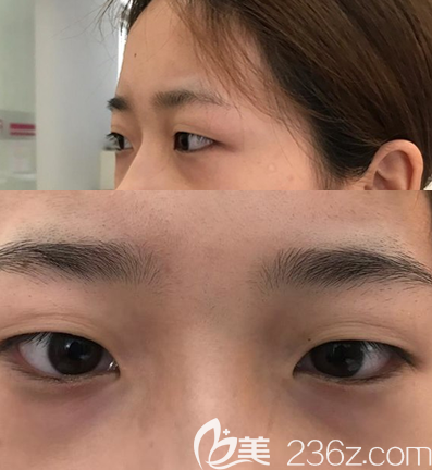 做帕克雙眼皮術(shù)前眼部情況 做帕克雙眼皮術(shù)前眼部情況