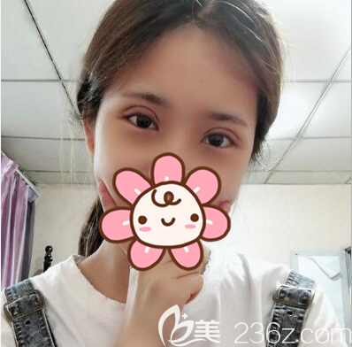 成都恒博李烈切開(kāi)雙眼皮拆線后效果 成都恒博李烈切開(kāi)雙眼皮拆線后效果