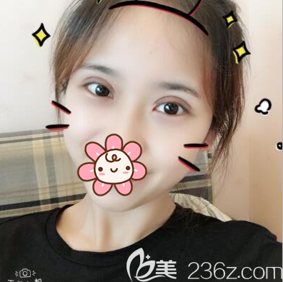 切開(kāi)雙眼皮術(shù)后一個(gè)月恢復(fù)效果 切開(kāi)雙眼皮術(shù)后一個(gè)月恢復(fù)效果